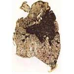 Black Lung Disease