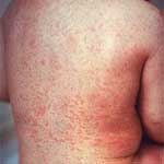 Rubella